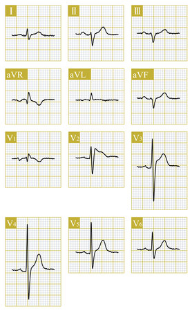 Male, 66 years old, received chemotherapy for esophageal cancer. Type II Brugada phenotype appears on ECG, which needs to be differentiated from primary Brugada syndrome.の写真素材