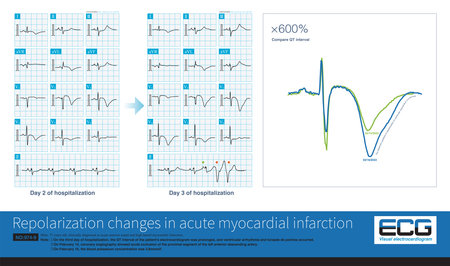 In acute myocardial infarction, the dynamic change of repolarization and prolongation of QT interval are the hallmarks of torsade de pointes.の写真素材