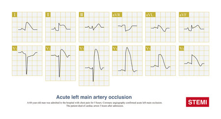 Acute left main artery occlusion can cause both ST segment elevation and non ST segment elevation myocardial infarction, regardless of which type, the risk of death is high.の写真素材