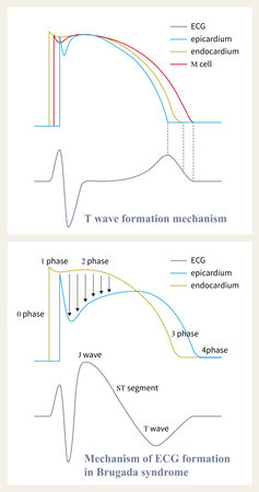 The mechanism of Brugada syndrome is the difference of repolarization phase 1 and 2 between epicardium and endocardium, and the loss of epicardial plateau leads to ST elevation.の写真素材