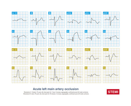 When acute left main artery occlusion occurs, QRS wave of ECG can be normal, or wide QRS wave can occur with intraventricular block, and the prognosis of the latter is worse.の写真素材