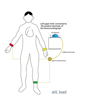 The positive pole of aVL lead is placed on the left upper limb, and the negative pole is an improved central terminal, which is actually a bipolar lead.の写真素材