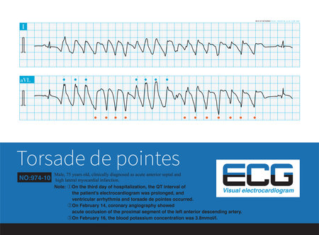 During an episode of torsade de pointes, the polarity of the QRS complex is reversed around the isoelectric line of the ECG, but some leads are more consistent in polarity.の写真素材