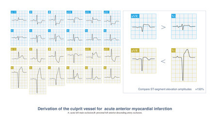 In acute extensive anterior myocardial infarction, the culprit vessel may be occlusion of the left main artery or proximal left anterior descending artery.の写真素材