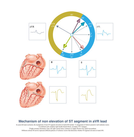 When acute left main trunk occlusion occurs, the ST segment of aVR lead may not be elevated, which...