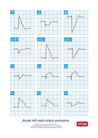 Acute left main artery occlusion can cause both ST segment elevation and non ST segment elevation myocardial infarction, regardless of which type, the risk of death is high.の写真素材