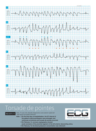 During an episode of torsade de pointes, the polarity of the QRS complex is reversed around the isoelectric line of the ECG, but some leads are more consistent in polarity.の写真素材