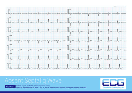 The absent septal q wave in ECG may be a normal variant, and the pathological reasons are ventricular septal fibrosis, intraventricular block and myocardial disease.の写真素材