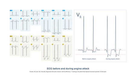 During the attack of angina pectoris, the degree of ST segment depression increased, and the T wave...