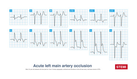 Acute left main artery occlusion can cause both ST segment elevation and non ST segment elevation myocardial infarction, regardless of which type, the risk of death is high.の写真素材