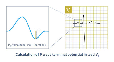 The negative part of P wave in lead V1 carries the electrical information of the left atrium, and the increase of amplitude and duration indicates that the left atrium is diseased.の写真素材