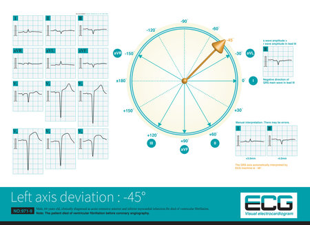 When AMI causes myocardial necrosis of the posterior inferior wall of LV, the depolarization potential to the right, inferior, and back is lost, and the left axis deviation.の写真素材