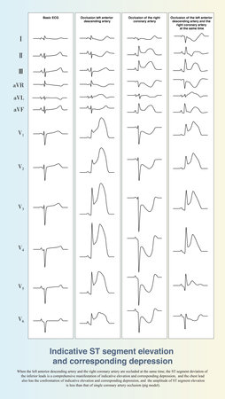 When both two coronary arteries are occluded, the ST elevation of the ischemic myocardium on one...