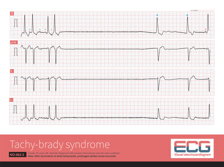 Tachy-brady syndrome is a special type of in which bradycardia and tachycardia are repeated alternating episodes. This ECG recorded episodes of paroxysmal atrial fibrillation.の写真素材