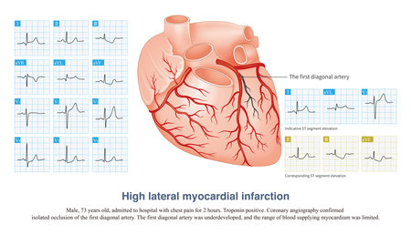 In acute high lateral myocardial infarction, there is indicative ST segment elevation in leads I and aVL, and corresponding ST segment depression in leads II, III and aVF.の写真素材