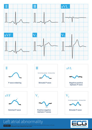 The ECG changes of left atrium abnormality include widening of P wave duration, bimodal P wave, increasing of P wave terminal potential in lead V1 lead P wave.の写真素材