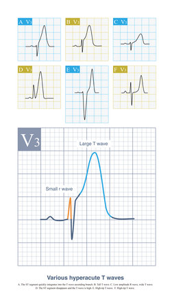 Under different diseases and pathophysiological conditions, the hyperacute T wave of acute myocardial ischemia can have various forms.の写真素材