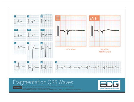 Fragmentation QRS wave refers to the three-phase wave or multiphase wave of QRS wave, which is an electrocardiogram indicator that reflects myocardial health.の写真素材