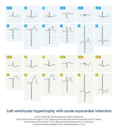 When the left ventricle is hypertrophic, the right chest lead will have ST segment elevation, which is easy to be misdiagnosed as AMI, and patients generally have no chest pain.の写真素材
