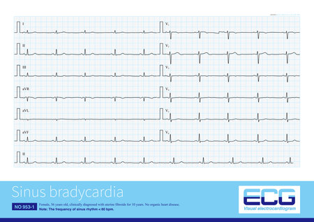 Sinus bradycardia refers to the frequency of impulses issued by the sinus node less than 60 beats per minute, and the ECG shows a slow sinus rhythm.の写真素材
