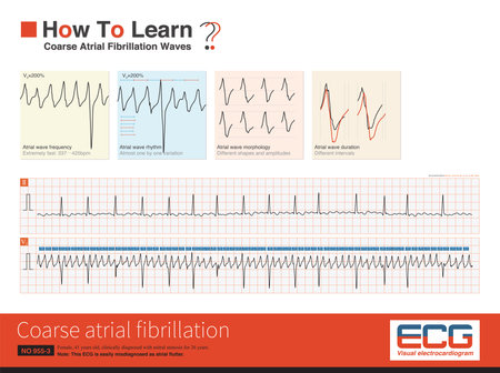 Sometimes, coarse atrial fibrillation is easily misdiagnosed as atrial flutter, but their shape, amplitude and frequency are almost beat by beat changes.の写真素材