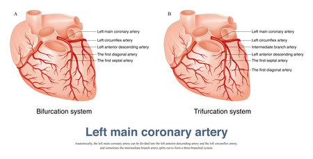 The left main coronary artery can be divided into the left anterior descending artery and the left circumflex artery, and sometimes the intermediate branch artery.の写真素材
