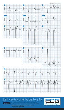 When aortic valve regurgitation occurs, in diastole, blood returns from the aorta to the left ventricle, and the volume of return blood from the left atrium causes LVH.の写真素材