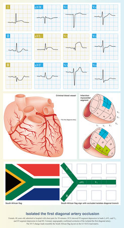 When the isolated first diagonal artery is occluded, ECG can show ST segment elevation in leads I, aVL, and V2, and ST segment depression in lead III.の写真素材