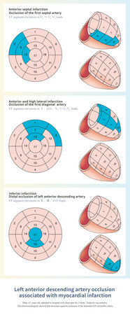 Occlusion of the left anterior descending artery in different parts causes different ranges of left ventricular infarction and different ECG changes.の写真素材