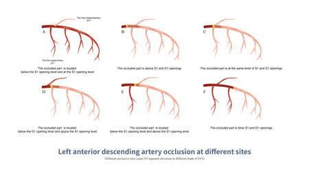When different parts of the left anterior descending artery are occluded, the distribution of ST segment elevation leads in ECG is different, so the occluded part can be deduced.の写真素材
