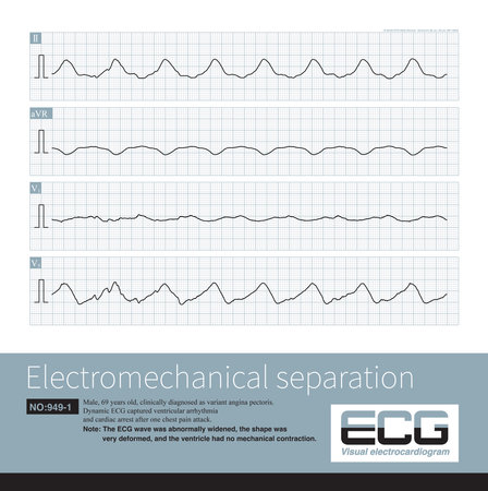 Electromechanical separation is a kind of terminal ECG. The patient's ECG has electrical signals, the ECG wave is widened with morphological abnormalities.の写真素材