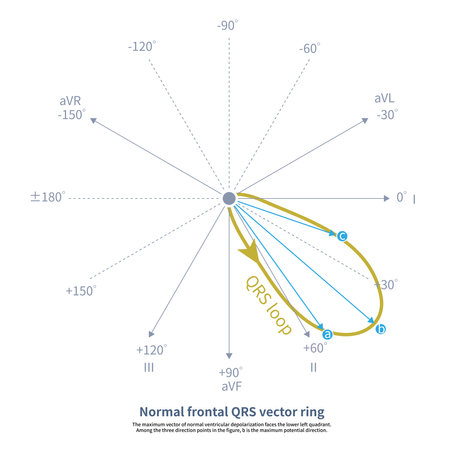 When ventricular depolarization occurs, the maximum QRS potential of the comprehensive depolarization potential on the front plane determines the orientation of the QRS axis.の写真素材