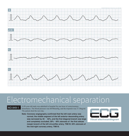 Electromechanical separation is a kind of terminal ECG. The patient's ECG has electrical signals, the ECG wave is widened with morphological abnormalities.の写真素材
