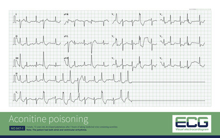 In aconitine poisoning, the atrium is inhibited, the amplitude of P wave decreases or atrial fibrillation occurs and ventricular triggering activity increases.の写真素材