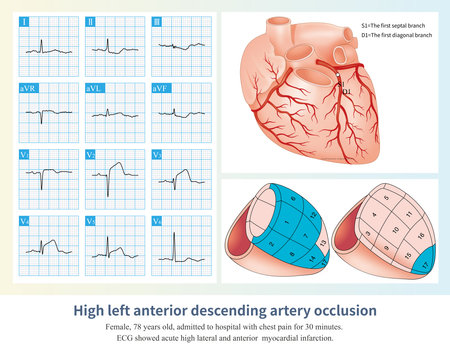 When the occlusion of the LAD is located in the common trunk above the opening of the first septal branch and the first diagonal branch, a large area left ventricular infarction.の写真素材