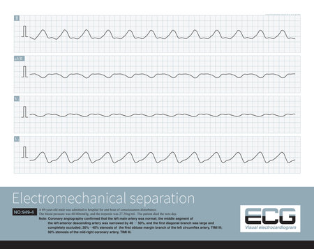 Electromechanical separation is a kind of terminal ECG. The patient's ECG has electrical signals, the ECG wave is widened with morphological abnormalities.の写真素材