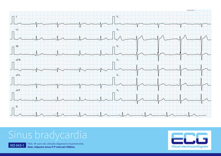 Generally, when the sinus heart rate is below 60 beats per minute, it is called sinus bradycardia. This arrhythmia can be both physiological and often pathological.の写真素材