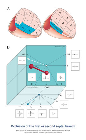When the isolated first or second septal branch is occluded, the ischemic potential faces the right, anterior, and superior, resulting in ST segment elevation in V1 to V3 leads.の写真素材
