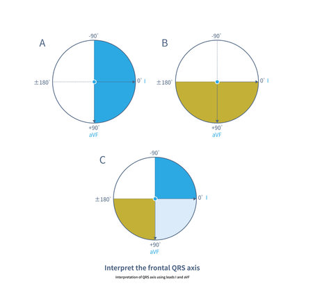 The blue and grassy yellow areas are QRS positive distribution range in lead I and aVF respectively; the light blue area is QRS positive distribution range in both lead I and aVF.の写真素材