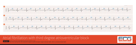 Once atrial fibrillation exhibits a slow and regular ventricular rhythm, it is important to be alert to 3Â° AVB.の写真素材