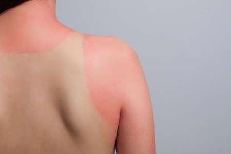 sunburnの写真素材