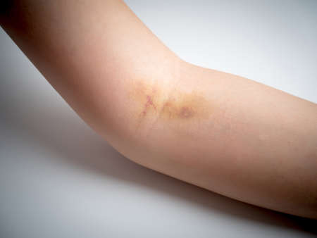 bruises on woman arm skinの写真素材