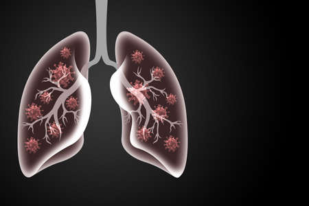 respiratory virus and coronavirus outbreak. coronavirus or COVID-19, the virus that causes pneumonia as a medical health risk with infected human lungs. 3D renderingの写真素材