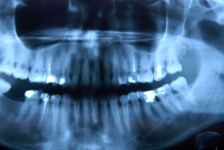 x-ray – panoramic photo of roentgen – jaw, mandible