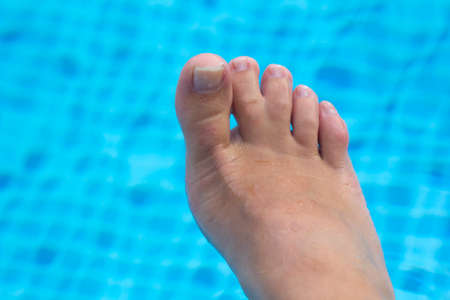 Webbed toes, woman Right Foot With Veins and Webbed Toes on blue pool background. genetic disorders...