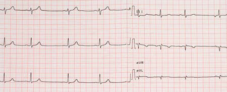 Electrocardiogram example of a normal 12-lead sinus rhythm, medical conceptの写真素材