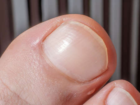 Close-up of a big toe of the right foot. Details of the of the unevenly cut toenail and a small slightly raised dark blemish on the skin.の写真素材