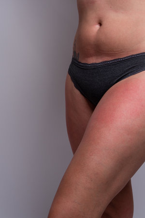 Close up of woman with sunburn on legs. Displaying one leg with no faceの写真素材