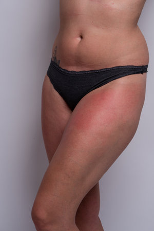 Close up of woman with sunburn on legs. Displaying one leg with no face