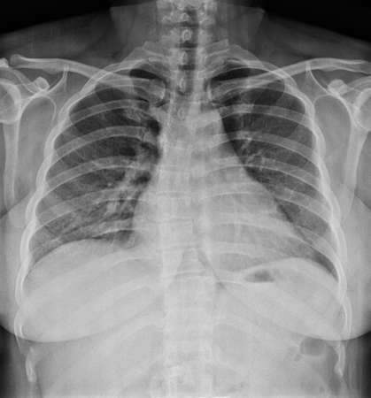 A chest x-ray image for a medical diagnosis.の写真素材